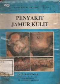 Image of Penyakit Jamur Kulit