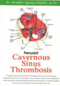 Penyakit cavernous sinus thrombosis